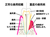 歯周病、正常・異常の図